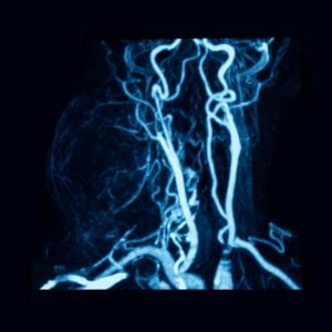 Contrast-enhanced magnetic resonance angiography of the neck with chronic lymphocytic thyroiditis (or autoimmune thyroiditis)
